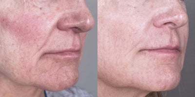 67-year old woman treated with Ellacor - This 67-year-old female underwent Ellacor micro-coring treatment, which significantly improved skin laxity and fine lines, revealing a firmer, more youthful jawline and smoother complexion.