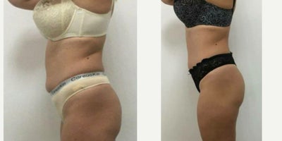 35-44 year old woman treated with Evolve, Semaglutide - Treated by Tracy Kwan, PA and Alyssa G, laser tech