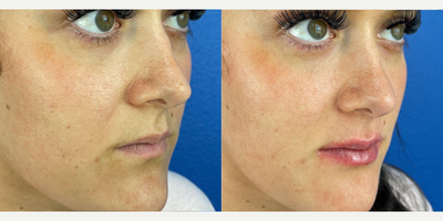 25-34 year old woman treated with Lip Fillers - Added lip filler to provide volume to this patient's lip