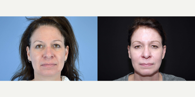 45-54 year old woman treated with ArteFill - 50 year old female patient received 4 syringes of Bellafill to her nasolabial folds, marionettes, and temples; photos depict the patient's results 2 years post-treatment.