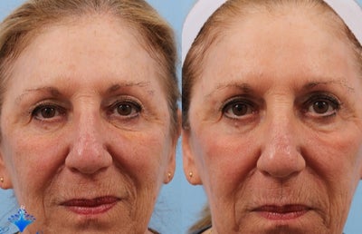 65-74 year old woman treated with Laser Treatment - Diminished sunspots and improved skin quality after one Pixel fractionated CO2 laser treatment.
