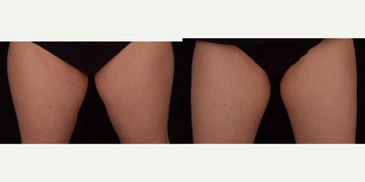35-44 year old woman treated with SculpSure - This patient was concerned about the stubborn fat on her inner and outer thighs that was difficult to get rid of through diet and exercise. Results demonstrate before and after one SculpSure treatment to her inner and outer thighs. The treatment only took 25 minutes.