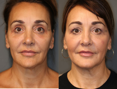 Pan Facial Rejuvenation - Upper and lower lid filler, temple and jawline rejuvenation.