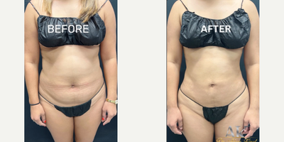 Woman treated with Laser Liposuction - Its all about confidence. Sometimes just a few little changes can make a world of difference to how you feel about yourself. Our patient received lipo360+ with a fat transfer. Now she is enjoying an hour glass figure. .