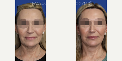 Woman treated with CO2 Laser - Another FACEologyLIFT + CO2 Laser Performed by Dr. Raymond Lee