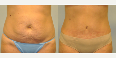 35-44 year old woman treated with Tummy Tuck - 37 year old female one year following a Tummy Tuck with repair of her muscle separation, using a drainless technique.