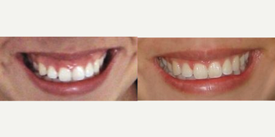25-34 year old woman treated with Lip Lowering - This patient came in for a consultation with Dr. Alex Farnoosh because she felt that her smile was less attractive because it exposed so much of her gums. Her gummy smile was treated with upper lip lowering so the upper lip appears to be more full.