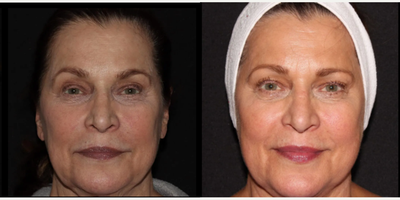 Woman treated with Emface - Emface