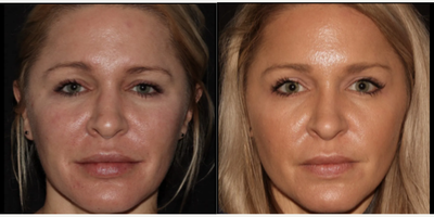 Woman treated with Emface - Emface