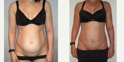 45-54 year old woman treated with Panniculectomy - Mini abdominoplasty and hernia repairDr Damien GrinsellRegistered medical practitioner, specialist plastic surgeon(Speciality registration in surgery - plastic surgery)AHPRA Registration: MED0001207555Any invasive procedure carries risks and individual results may vary depending on genetic factors, not limited to but including age, genetics, diet, lifestyle and existing medical conditions. Outcomes shown are only relevant to this patient and do not necessarily reflect the results other patients may experience. Before any surgery, we recommend you consult a qualified health practitioner who should discuss at length these risks, including possible outcomes and recovery/aftercare instructions specific to your procedure. If unsure, always seek a second opinion from a specialist plastic surgeon.