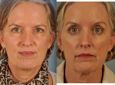 Phenol Peel - 
	52 year old woman desired a more youthful appearance but did not want a facelift. Dr. Robinson suggested an Endoscopic Brow Lift with a full face Hetter Peel.
