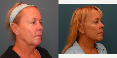55-64 year old woman treated with Neck Lift - Lower Face and Neck Lift. Patient is scheduled to undergo Upper and Lower Lid Blepharoplasty.