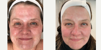 45-54 year old woman treated with Dermapen - Micro needling with prp 3 sessions over 3 months in patient with severe acne and procedural scarring