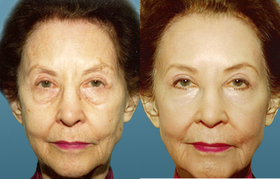 Skin Resurfacing - Before and After - 
	Skin Resurfacing - Before and After
