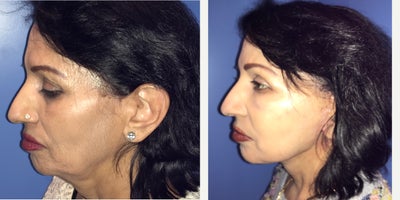 55-64 year old woman treated with Facelift - Patient is 2 months post op