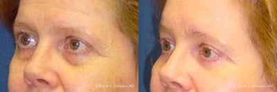 Woman treated with Brow Lift - Woman treated with Brow Lift