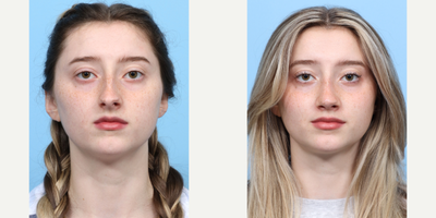18-24 year old woman treated with Rhinoplasty - This 20-year-old patient wanted to reduce the bridge of her nose, improve her nasal tip and dorsal profile. Dr. Wise performed a rhinoplasty to create a nose that looks more natural and better suits her facial proportions.