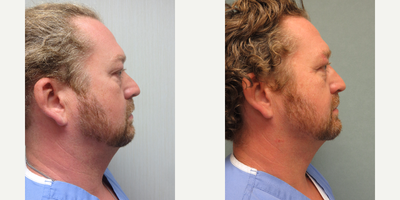 35-44 year old man treated with Kybella - Submental area treated with 2 teatments of Kybella