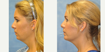35-44 year old woman treated with Chin Implant - Surgical Procedure: Chin Implant
