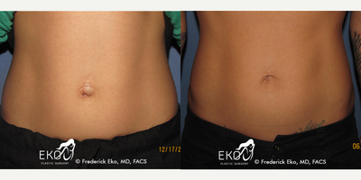 25-34 year old woman treated with Umbilical Hernia Repair - 25-34 year old woman treated with Umbilical Hernia Repair