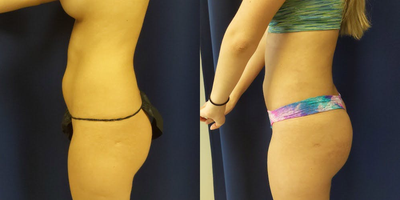 25-34 year old woman treated with Liposculpture - Another prime example of the effects of lipo contouring even in petite women. And improved curvature can be seen in this already thin woman who desired reshaping her waistline.