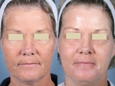 Laser Peel Treatments - 
	45 year old female before and after CO2 and Erbium resurfacing for the deep wrinkles around her mouth. I used plasma skin regeneration to resurface the rest of her face.
	&nbsp;
