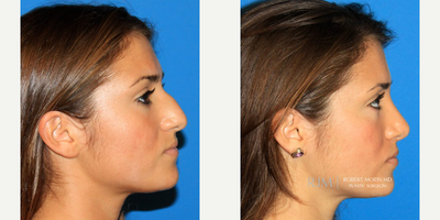 18-24 year old woman treated with Rhinoplasty, Septoplasty - Patient's 3 Story: A rhinoplasty and septoplasty was performed on this 19 year old college student with a history of nasal trauma. Surgical correction of her deviated nose, dorsal hump and bulbous tip was performed. These procedures resulted in a straight nose, a smooth flat nasal dorsum, better tip projection and definition and an overall beautiful result.