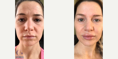 Woman treated with Restylane - I specialize in both surgical and non-surgical facial rejuvenation. Using a combination of injectables, I erase wrinkles, restore volume and provide an overall enhanced facial appearance. For my beautiful patient who submitted her photos, I used a combination of Botox and Restylane products to achieve the smooth and renewed look she is so happy with. Join me and together we will create a treatment plan specifically for you.