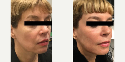35-44 year old woman treated with Sculptra, Restylane, Botox, Dysport - This patient wanted the results of a facelift without surgery. She felt like she was tired and felt she looked old for her age. We treated her with Sculptra, adding subtle global volume, but focusing on the mid-face, and jowl/ jawline area. She later had a bit of botox to smooth out her forehead and around the eyes.