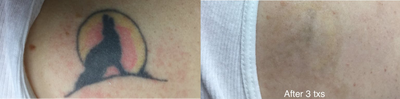 35-44 year old man treated with Enlighten laser tattoo removal - This patient was treated three times with the enlighten Tattoo Removal laser and the addition of the PFD Patch.