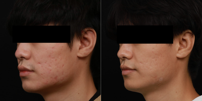 25-34 year old man treated for Acne scarring with a Combination Treatment Approach - Patient was treated with Fraxel re:store (non-ablative laser resurfacing) , Intracel (microneedling with radio frequency) as well as Platelet-Rich Plasma to address acne scarring. Photos show an improvement in textural irregularities and smoother skin.