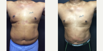 45-54 year old man treated with Vaser Liposuction - Upper and lower abdomen, lateral chest, anterior waist and flank