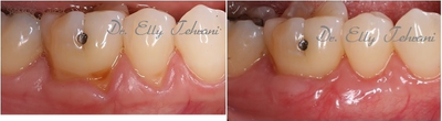 45-54 year old female treated with Gum Graft - Female patient with recession and root sensitivity on the lower right area.&nbsp; The site was treated with gum grafting technique with the tissue harvested from the palate to cover the exposed roots.