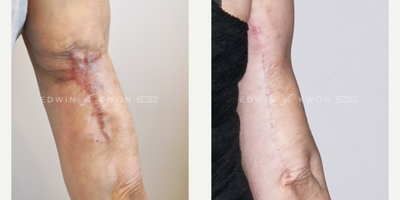 45-54 year old woman treated with Scar Removal - 45-54 year old woman treated with full thickness skin loss on posterior arms following VASER liposuction. Patient's arms were treated with 3 rounds of fat transfer with excision of the contracted scar as a final stage reconstruction. Patient continuing to undergo microneedling of the surgical scar.