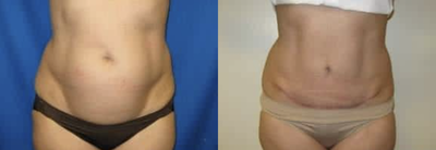 Woman treated with Mini Tummy Tuck - Case:19212 Gender:Female Description:This is a Mini Tummy Tuck where only the lower abdominal region is addressed. This avoids an incision around the belly button.*After photos were taken 6 Months after surgery/procedure.