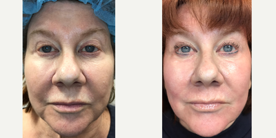 55-64 year old woman treated with J-Plasma Skin Rejuvenation - J-Plasma skin resurfacing. Before and two weeks after treatment. Please view the accompanying video to see the recovery process.