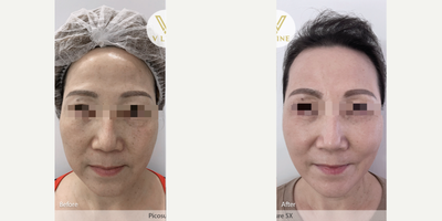 55-64 year old woman treated with PicoSure - Client's result after 5 sessions with 1 session per month of Picosure Laser for pigmentation removal and skin lightening.