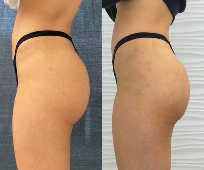 Woman treated with Renuva - Woman treated with Renuva
