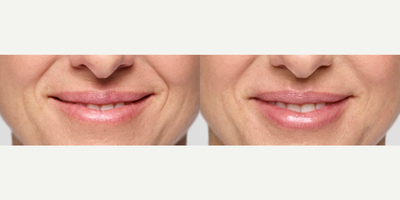 Woman treated with Restylane Silk - Photo provided courtesy of Galderma
