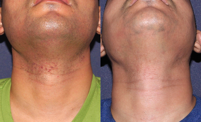 18-24 year old man treated with Laser Hair Removal - Leysin Fletcher, PA-C, performed laser hair removal to treat this patient ingrown hairs, red bumps and to remove the hair.