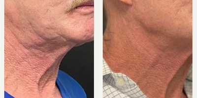 Man treated with Morpheus8 - Man treated with Morpheus8