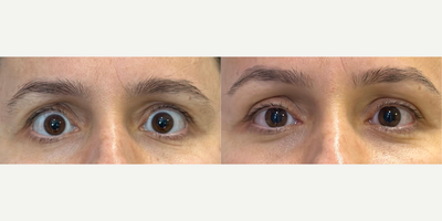 Woman treated with Eyelid Retraction Repair - Abnormal elevation of the upper lids, referred to as upper eyelid retraction, can result from various causes. This condition poses cosmetic challenges, as the patient consistently appears alarmed or displeased, and it also gives rise to functional issues such as lagophthalmos and exposure keratopathy. The provided photo shows the patient's condition on the 10th day post-operation.