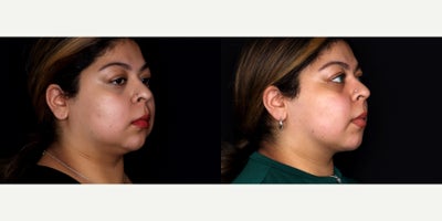 23 year old woman treated with Liposuction, PrecisionTx, Facial Fat Transfer to chin - 23 year old female treated with liposuction to face and submental neck (Precision tx) and fat transfer to the chin. Photos depict before and 3 months after surgery
