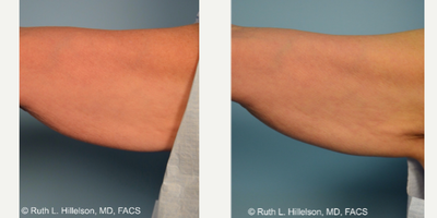 55-64 year old woman treated with Thermage FLX - Patient had Thermage FLX of the arms to help with skin laxity.