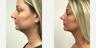 Kybella Bergen County NJ - 35 year old shown before and after Kybella treatment of the area beneath her chin. Two vials per session for three sessions over a six month period were completed. The patient also had a ten pound weight loss.