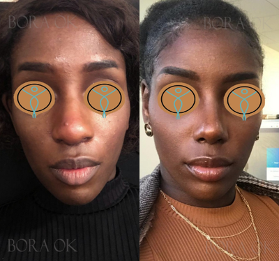 25-34 year old woman treated with African American Rhinoplasty - 25-34 year old woman treated with African American Rhinoplasty