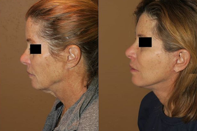 Woman treated with Cheek Lift - Woman treated with Cheek Lift