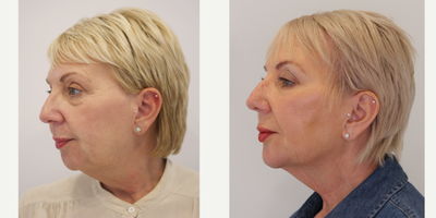 55-64 year old woman treated with Nonsurgical Facelift, Carboxytherapy, Dermal Fillers - This beautiful patient tough that surgery is the only option to help her to reduce eye bags. I have formulated a complex treatment plan that was involve use of combination therapies : non surgical face lift with Dermal fillers , following carboxy therapy for eye bags and tear trough treatment .Maintanace program :Anti -wrinkle treatment every 4 month Dermal fillers annual 5-7 mls 5 years later initial treatment with righ maintanance regime she looks and feels fabulous
