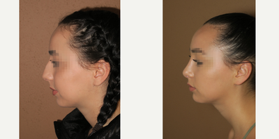 25-34 year old woman treated with Rhinoplasty - rhinoplasty