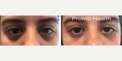 Woman treated with Sculptra, Hyaluronidase - Woman treated with Sculptra, Hyaluronidase